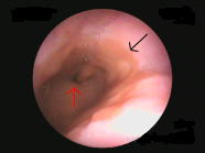 食道裂孔ヘルニア