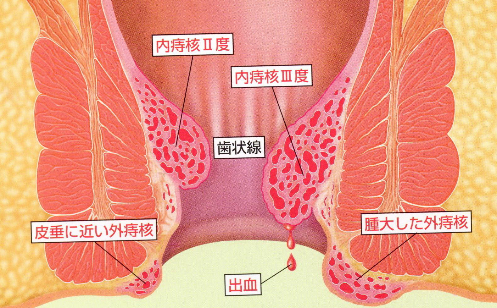 いぼじ（痔核）解説