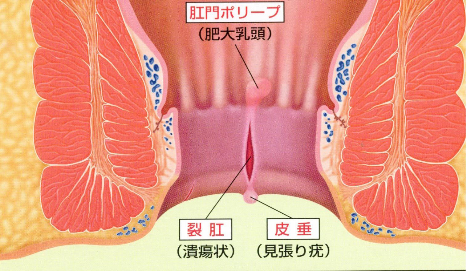 切れ痔の解説