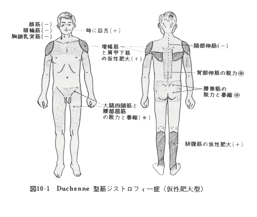 仮性肥大型筋ジストロフィー症図